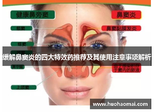 缓解鼻窦炎的四大特效药推荐及其使用注意事项解析